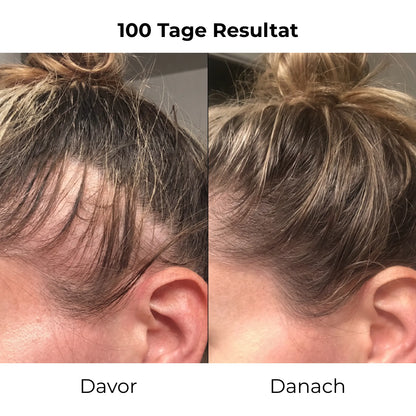 Reclara Bürste – Die Natürliche 4-in-1 Haarwuchsbürste